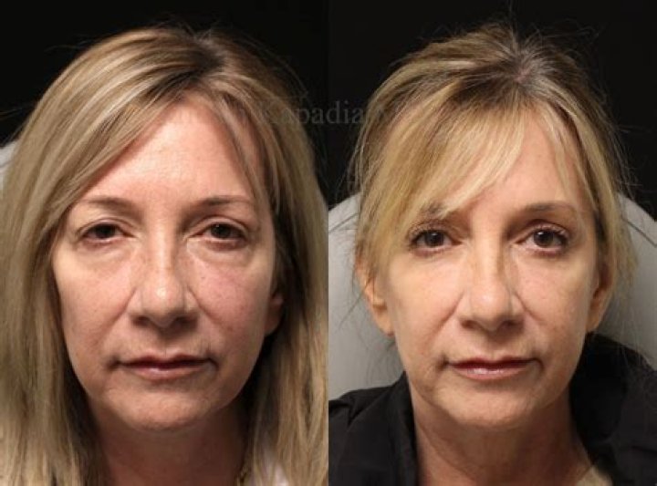 Annie Potts Surgery: Before And After Photos