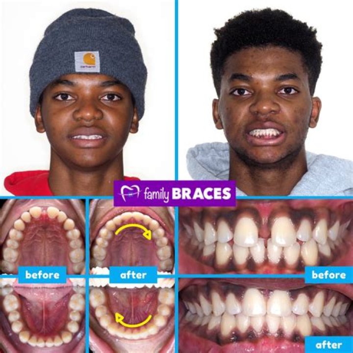 Central Cee Teeth Before And After: Has He Used Braces?