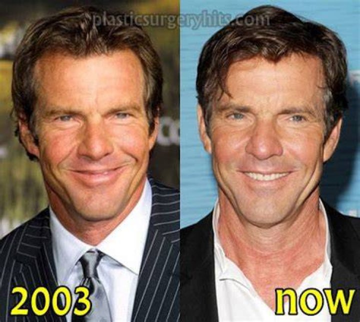 Dennis Quaid Before And After Plastic Surgery YouTube