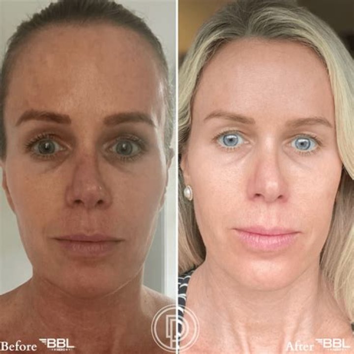 Himynamestee BBL Surgery: Before And After Photos