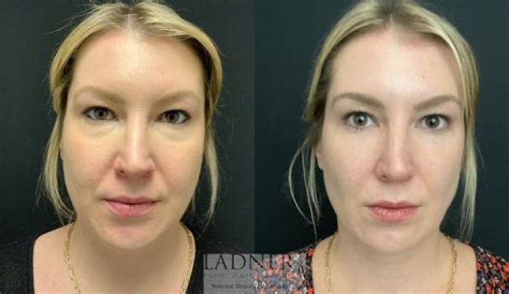 Lindsey Married At First Sight Plastic Surgery: Before And After Photos