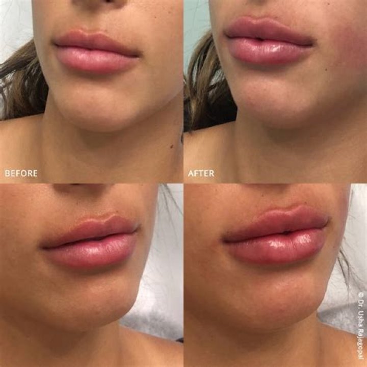 Nose Job And Lip Filler Rumors